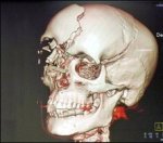 maria-de-villota-skull-damage-crop.jpg